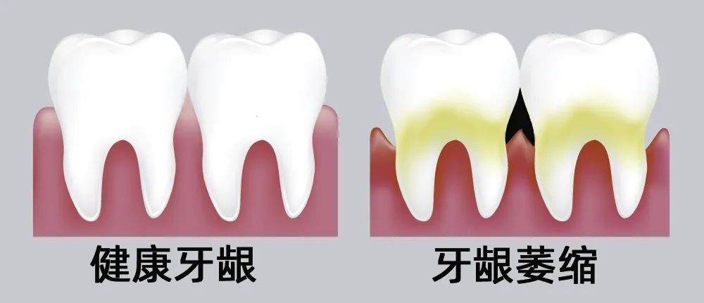 牙縫大露出“黑三角”，既塞牙又難看！還能恢復嗎？